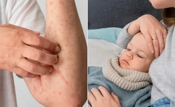 Nebezpečný vírus osýpok potvrdili v Bratislave. Dieťa, ktoré ochorelo, nebolo očkované