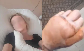 Bratislavčanka tvrdí, že jej chirurg v Ružinove dokaličil ruku, z funkčnej končatiny jej po operácii ostal zničený pahýľ