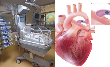 Lekári z NÚSCH majú za sebou unikátny zákrok, predčasniatku zoperovali srdce bez otvorenej operácie cez hrudník