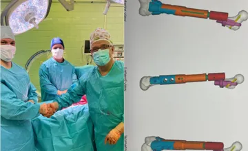 Bratislavskí lekári zachránili ako druhí v Európe pri properácii nádoru stehennej kosti mladému športovcovi oba kĺby