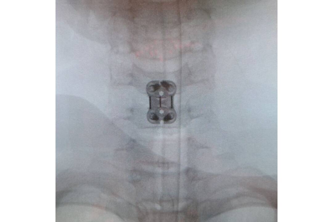 FOTO: Neurochirurgovia NÚDCH operovali vážne úrazy chrbtice, deti mohli skončiť na vozíku, foto 2
