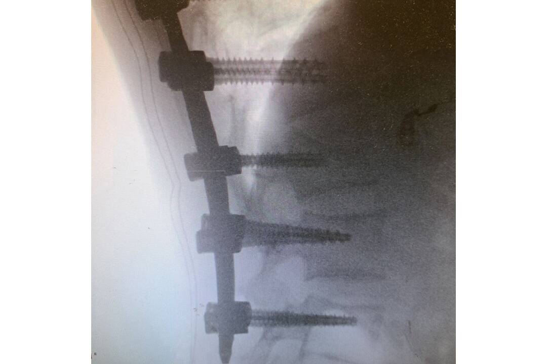 FOTO: Neurochirurgovia NÚDCH operovali vážne úrazy chrbtice, deti mohli skončiť na vozíku, foto 3