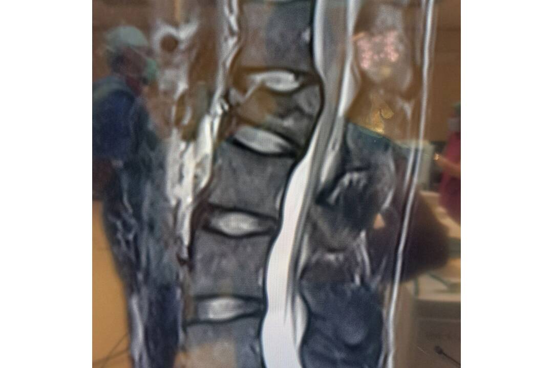 FOTO: Neurochirurgovia NÚDCH operovali vážne úrazy chrbtice, deti mohli skončiť na vozíku, foto 4