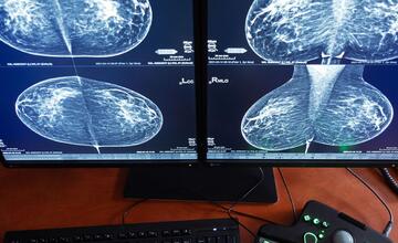 FOTO: V Nemocnici Malacky pribudol nový mamografický prístroj