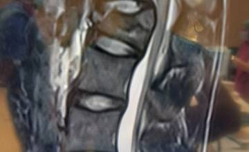 FOTO: Neurochirurgovia NÚDCH operovali vážne úrazy chrbtice, deti mohli skončiť na vozíku