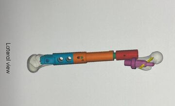 FOTO: Bratislavskí lekári zachránili pri operácii nádoru kosti obidva kĺby 